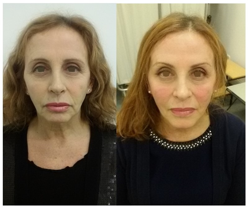 Antonella prima e dopo